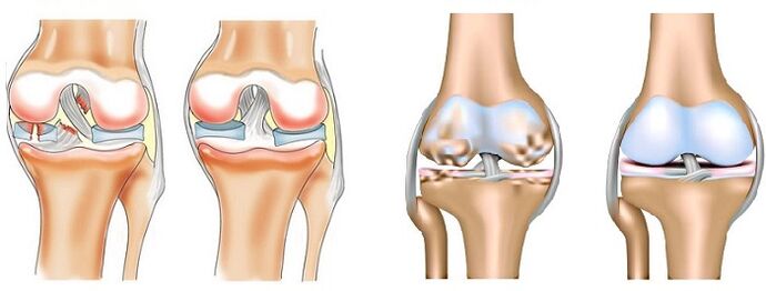 The difference between arthritis (left) and arthropathy (right) of the joints