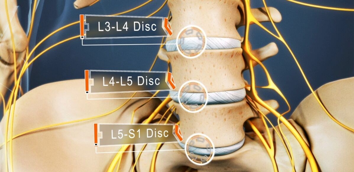The intervertebral discs of the lumbar spine, most commonly affected in osteosarcoma