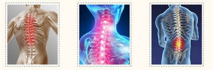Different spine fibrosis