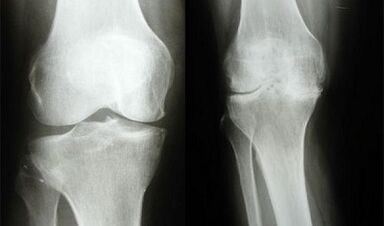 Knee diagnosis method