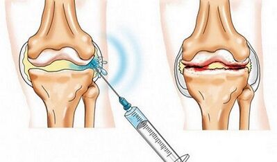 The blockade of knee joints for arthritis