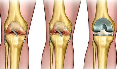 The level of development of knee joint disease