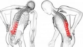 Intervertebral hernia - complications for osteoarthritis