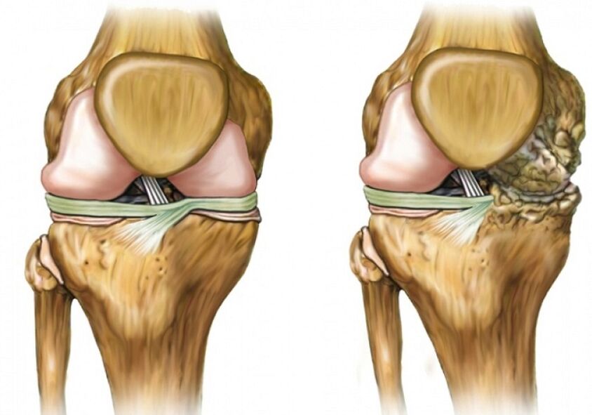 Knee joint pain