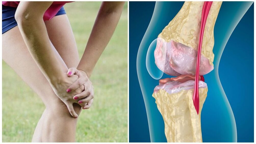 Symptoms of arthritis
