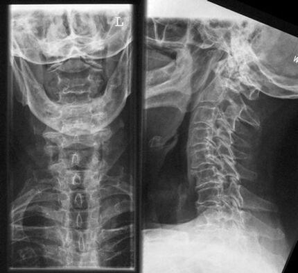 Cervical X -Ray - Method of diagnosis of osteoarthritis