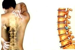 Back pain at different stages of development of cervical spondylosis