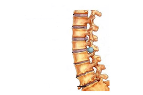 Spinal damage to cervical joint disease
