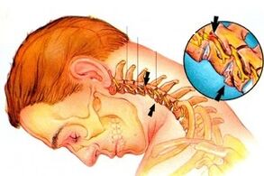 The pinch of the nerve in the spine with the cervical joint disease