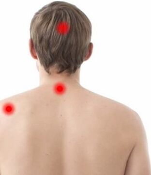 Pain location in cervical spondylosis
