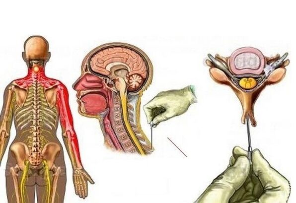 Treatment of cervical spondylosis with acupuncture