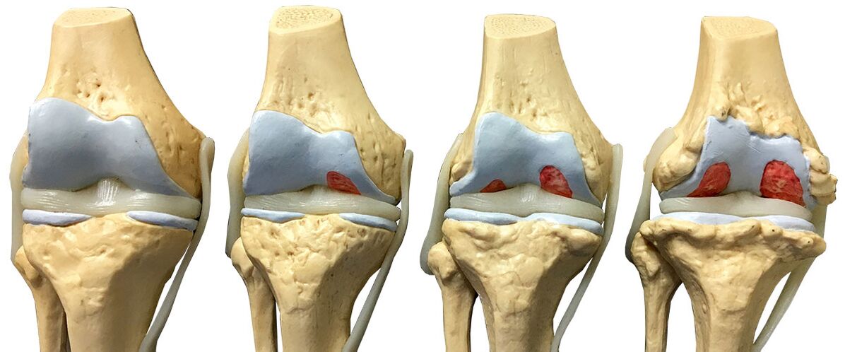 stages of joint disease