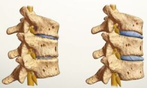 What does osteoarthritis look like