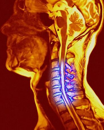 Cervical cartilage inflammation