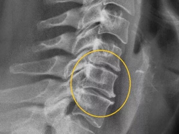 Cervical spine degeneration on X-ray